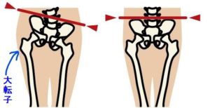 骨盤歪み