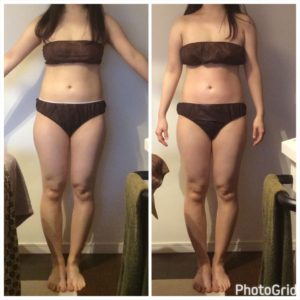 筋膜リリース&ハイパーナイフビフォーアフター