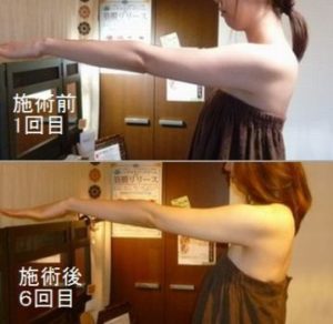 ハイパーナイフ 二の腕