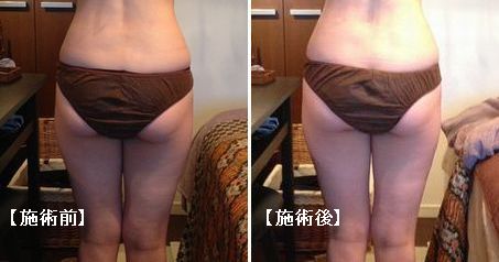 ハイパーナイフ 美脚 お尻
